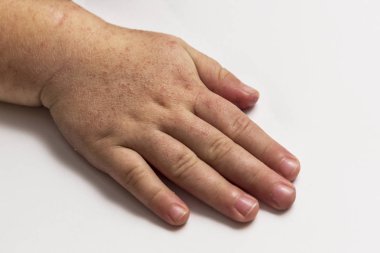 Scarlatina. Çocuk ellerimle bulaşıcı kırmızı küçük döküntü. Beyaz arka plan.