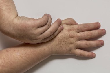 Scarlatina. Çocuk ellerimle bulaşıcı kırmızı küçük döküntü. Beyaz arka plan.