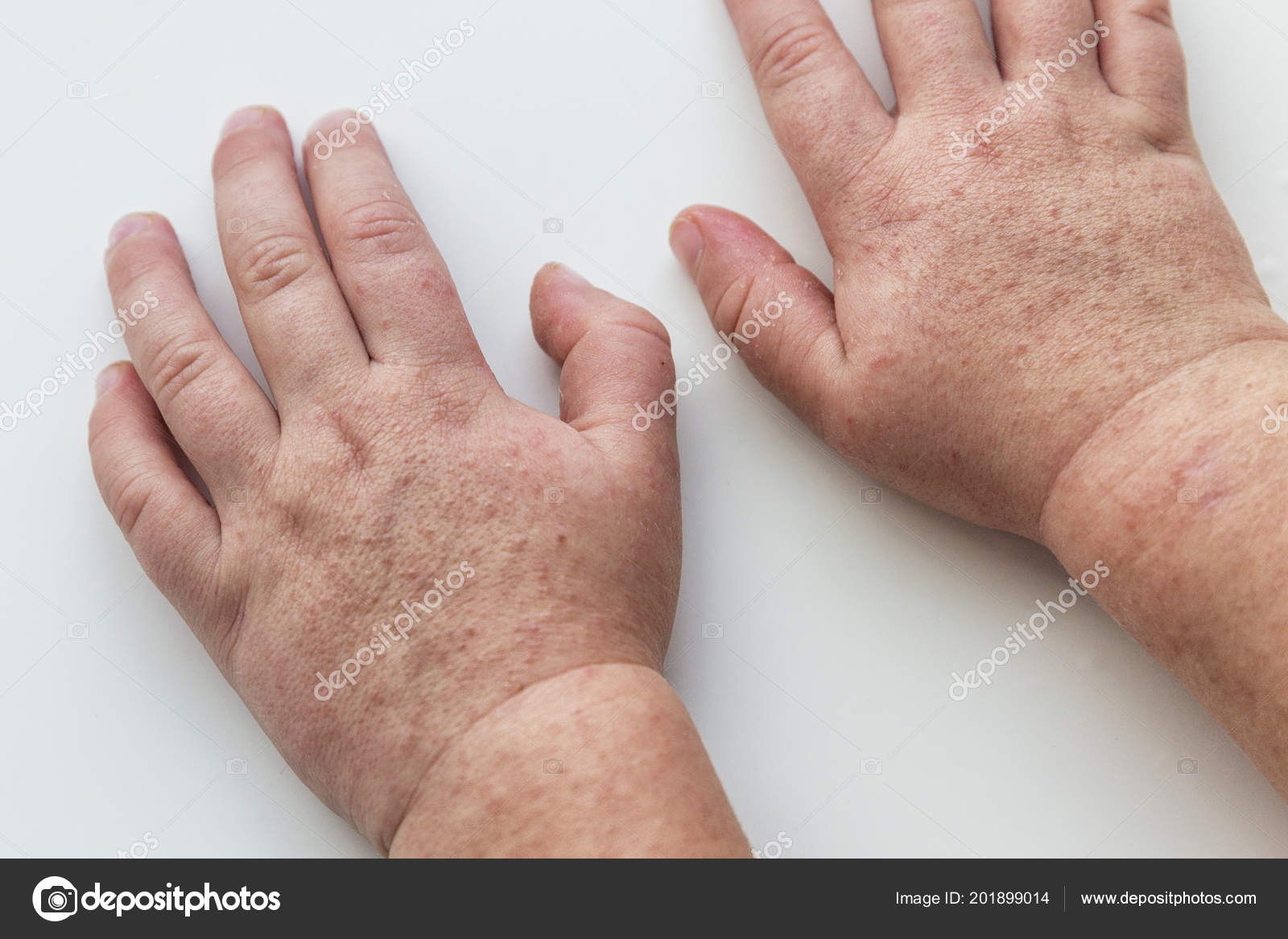 La escarlatina es contagiosa en ninos