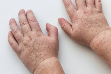 Scarlatina. Çocuk ellerimle bulaşıcı kırmızı küçük döküntü. Beyaz arka plan.