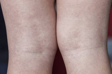 Scarlatina. İki çocuk bir bulaşıcı kırmızı küçük döküntü ile küçük bacakları. Beyaz arka plan.