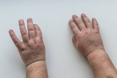 Scarlatina. Çocuk ellerimle bulaşıcı kırmızı küçük döküntü. Beyaz arka plan.