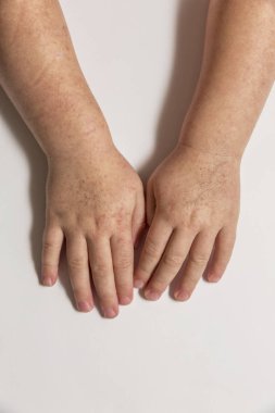 Scarlatina. Çocuk ellerimle bulaşıcı kırmızı küçük döküntü. Beyaz arka plan.