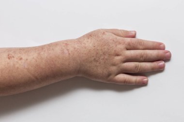 Scarlatina. Çocuk ellerimle bulaşıcı kırmızı küçük döküntü. Beyaz arka plan.