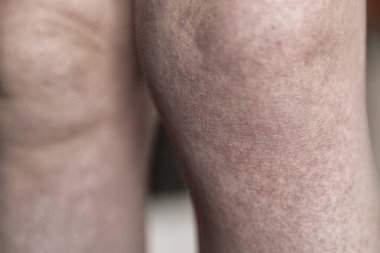 Scarlatina. İki çocuk bir bulaşıcı kırmızı küçük döküntü ile küçük bacakları. Beyaz arka plan.