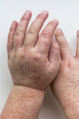 Scarlatina. Çocuk ellerimle bulaşıcı kırmızı küçük döküntü. Beyaz arka plan.