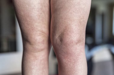 Scarlatina. İki çocuk bir bulaşıcı kırmızı küçük döküntü ile küçük bacakları. Beyaz arka plan.