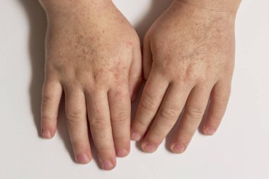 Scarlatina. Çocuk ellerimle bulaşıcı kırmızı küçük döküntü. Beyaz arka plan.