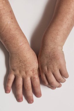 Scarlatina. Çocuk ellerimle bulaşıcı kırmızı küçük döküntü. Beyaz arka plan.