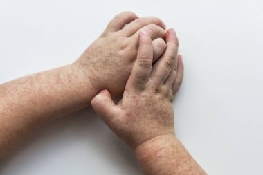 Scarlatina. Çocuk ellerimle bulaşıcı kırmızı küçük döküntü. Beyaz arka plan.
