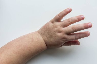 Scarlatina. Çocuk ellerimle bulaşıcı kırmızı küçük döküntü. Beyaz arka plan.