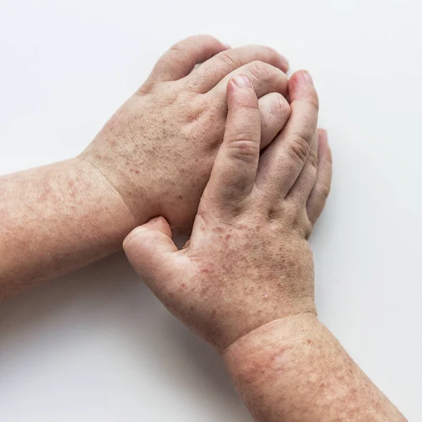 Scharlatina Zwei Kinderhände Mit Ansteckenden Roten Kleinen Hautausschlag Weißer Hintergrund — Stockfoto