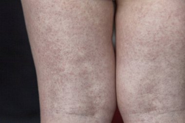 Scarlatina. İki çocuk bir bulaşıcı kırmızı küçük döküntü ile küçük bacakları. Beyaz arka plan.