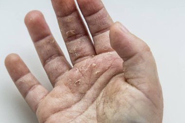 Scarlatina. Çocuk ellerimle bulaşıcı kırmızı küçük döküntü. Beyaz arka plan.