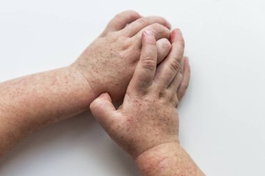 Scarlatina. Çocuk ellerimle bulaşıcı kırmızı küçük döküntü. Beyaz arka plan.