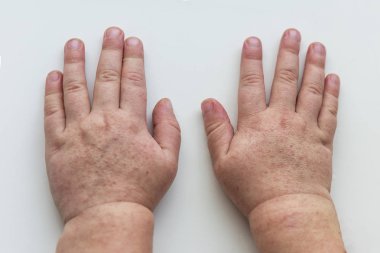 Scarlatina. Çocuk ellerimle bulaşıcı kırmızı küçük döküntü. Beyaz arka plan.