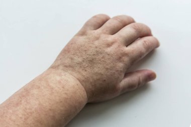 Scarlatina. Çocuk ellerimle bulaşıcı kırmızı küçük döküntü. Beyaz arka plan.