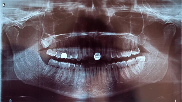 Muž Rentgenové Lékařství Stomatologie Problém Zuby Moudrosti Zuby — Stock fotografie