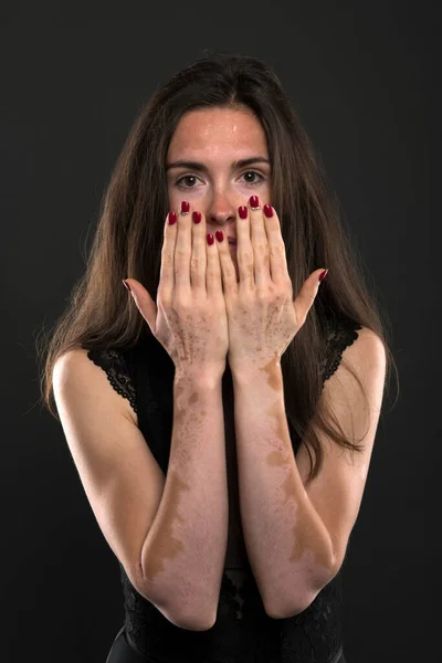 Porträtt Vacker Kvinna Med Vitiligo — Stockfoto
