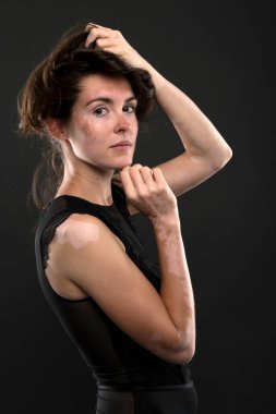 Vitiligo 'lu güzel bir kadının portresi