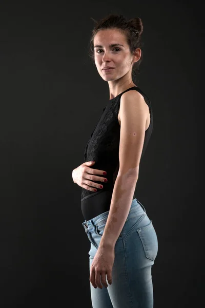 Retrato Mulher Bonita Com Vitiligo — Fotografia de Stock