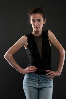 Vitiligo 'lu güzel bir kadının portresi