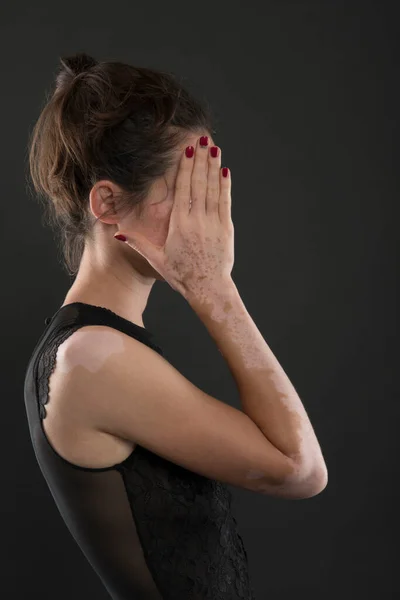 Retrato Mulher Bonita Com Vitiligo — Fotografia de Stock