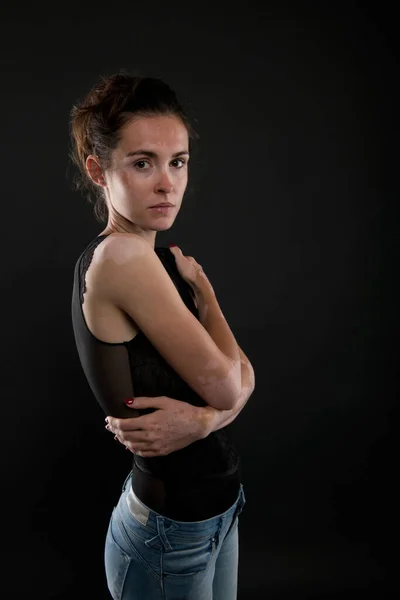 Retrato Mujer Hermosa Con Vitiligo —  Fotos de Stock