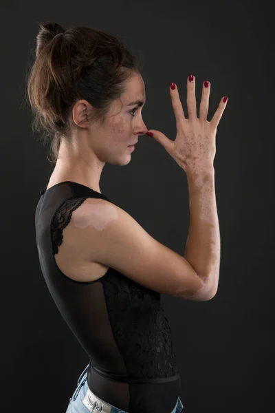 Portret Van Een Mooie Vrouw Met Vitiligo — Stockfoto