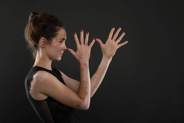 Retrato Mujer Hermosa Con Vitiligo — Foto de Stock