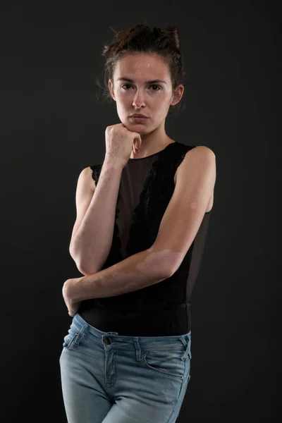 Portrait Belle Femme Avec Vitiligo — Photo