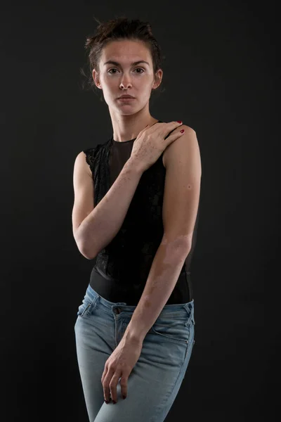 Portré Gyönyörű Vitiligo — Stock Fotó