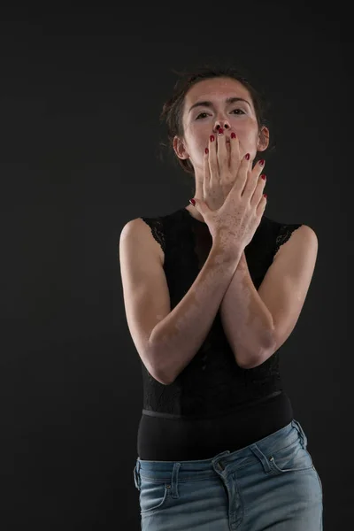 Portrait Belle Femme Avec Vitiligo — Photo