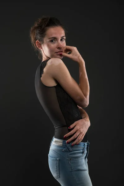 Retrato Mulher Bonita Com Vitiligo — Fotografia de Stock