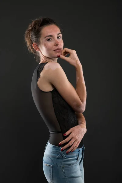 Retrato Mujer Hermosa Con Vitiligo — Foto de Stock