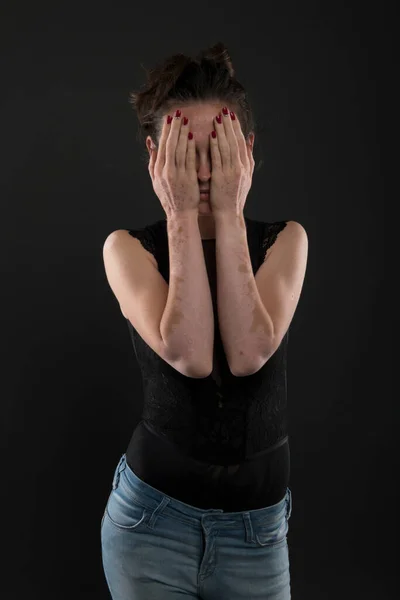 Portrait Belle Femme Avec Vitiligo — Photo