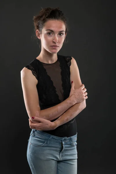Portré Gyönyörű Vitiligo — Stock Fotó