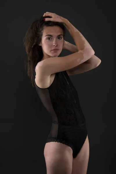 Retrato Mulher Bonita Com Vitiligo — Fotografia de Stock