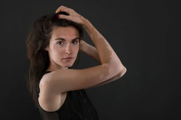 Retrato Mujer Hermosa Con Vitiligo — Foto de Stock