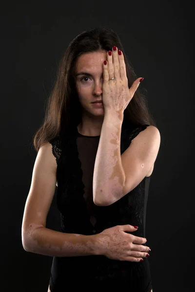 Portrait Beautiful Woman Vitiligo — Stock Photo, Image