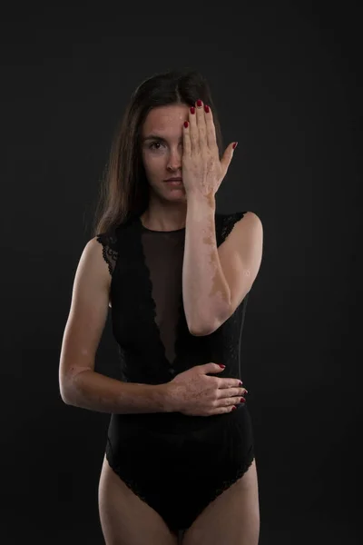 Retrato Mujer Hermosa Con Vitiligo —  Fotos de Stock