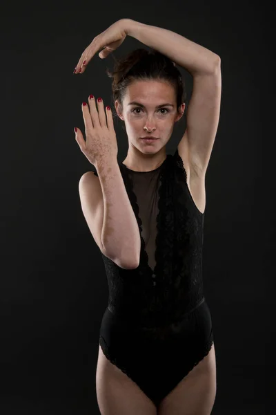 Retrato Mulher Bonita Com Vitiligo — Fotografia de Stock