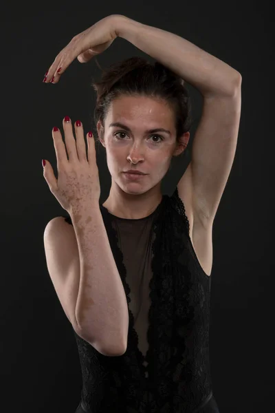 Retrato Mujer Hermosa Con Vitiligo —  Fotos de Stock