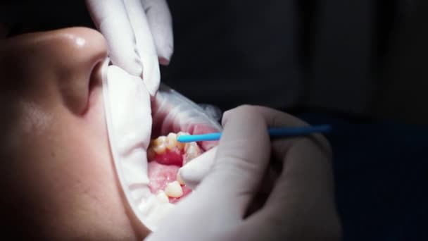 Jonge vrouw tandarts Receptie bij de orthodontist Vervanging van beugels Polijsten Gel bonding — Stockvideo