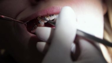 Lastik bantların diş tellerine yerleştirilmiş genç dişçi.