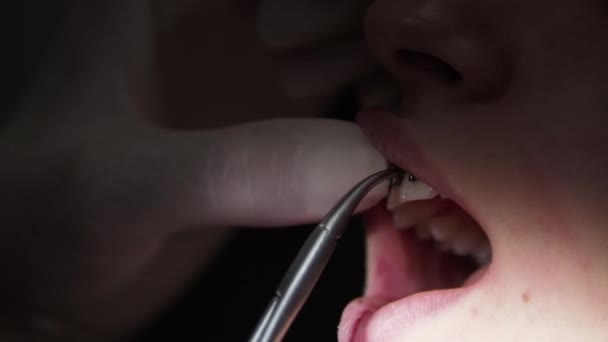 Ung kvinna tandläkare Ersättning av elastiska band på hängslen Mun närbild — Stockvideo