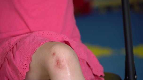 Knän trauma av ung kvinna med skrubbsår — Stockvideo