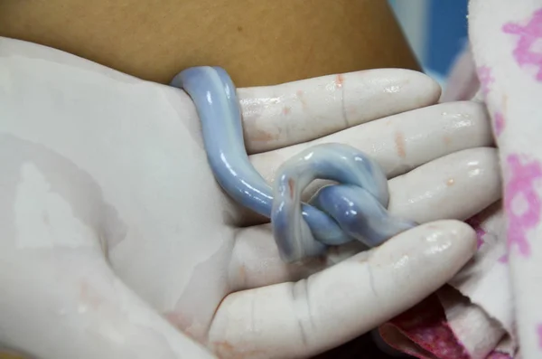 Umbilical cord of new born baby twisted into a knot. — Stock Photo, Image