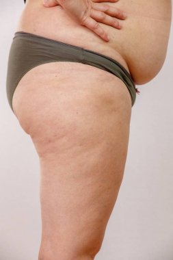 iç çamaşırı obezite kadın