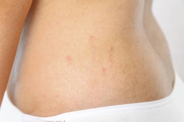 young overweighted woman in lingerie on white isolated background. side view. concept for medicine and cosmetology